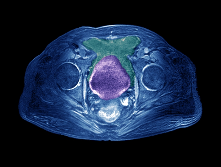 Prostate cancer. Coloured magnetic resonance imaging (MRI) scan of a section through the pelvis of a 65-year-old patient with prostate cancer. At centre is the prostate (purple), which has become enlarged due to cancer, the hip bones (round) are at either side of the prostate. At upper centre is the bladder (green) which has become indented by the enlarged prostate, causing obstruction to the neck of the bladder and impairing urination, the main symptom of prostate cancer. The causes of prostate cancer are not known, but it is most prevalent in men over 50 years of age. Treatment is with hormone therapy, chemotherapy, or surgery to remove the prostate.