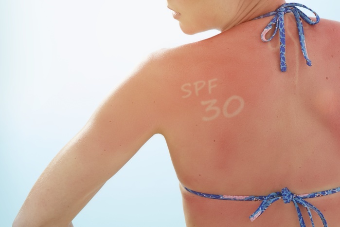 Woman with sunburnt back Woman with sunburnt back and  SPF 30  written on her shoulder.