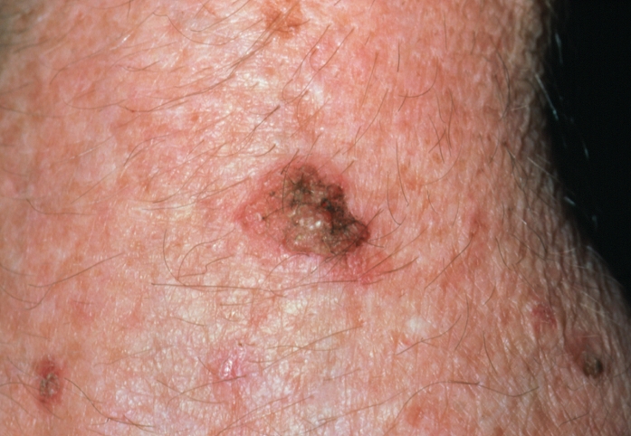 Skin disorder. Close-up showing a solar keratosis, a small wart-like, red skin growth which appears as a result of overexposure to the sunlight for a period of years. Solar keratoses may develop into skin cancer and for this reason must always be removed. Removal is performed by cryosurgery or by curettage with a spoon-shaped surgical instrument. The solar keratosis shown here was found on an elderly woman.