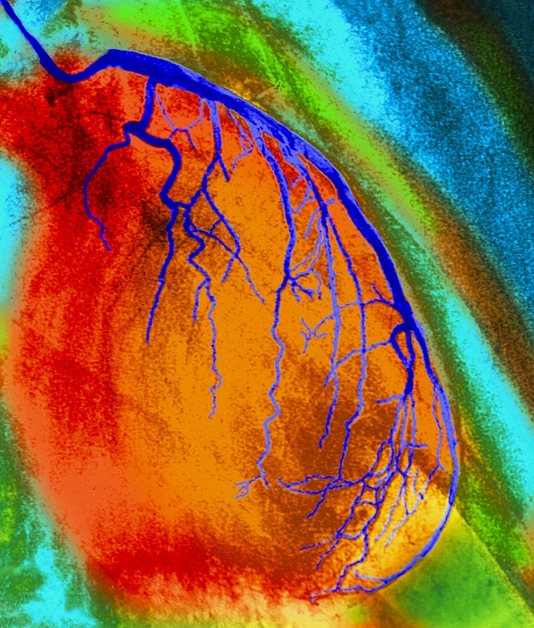 Coronary artery angiogram. Computer-enhanced coloured X-ray angiogram of coronary blood vessels (dark blue) that feed the muscle of the heart. The left coronary artery and its branches are seen here. They follow the rounded shape of the heart (orange). In the background, ribs (green) of the ribcage are visible. An angiogram is made by injecting the blood vessels of the patient with an X-ray opaque substance and then taking an X-ray. Blood vessels show up clearly, allowing conditions such as coronary artery disease (where the coronary artery narrows) to be identified. Blockages in the artery that lead to heart attack can also be identified.