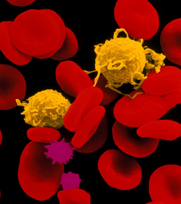 Red and white blood cells. Coloured Scanning Electron Micrograph of human red and white blood cells. Red blood cells, known as erythrocytes, are red biconcave discs. These contain the pigment haemoglobin which allows them to transport & supply oxygen to the body. The white blood cells seen here are lymphocytes (coloured yellow) which are involved in the body's immune response system. The purple cells seen are also red blood cells. The unusual shape of these crenated red blood cells may be symptomatic of a blood disorder but more normally is a result of prolonged storage of a blood specimen. Magnification: x3,100 at 6x7cm size. x2,250 at 6x4.5cm