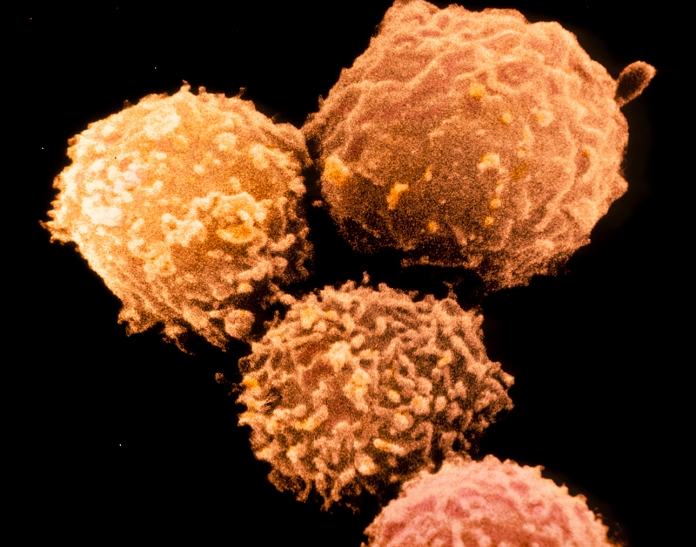 False-colour scanning electron micrograph (SEM) of human B-lymphocytes. They are white blood cells & one of the component cell types of the human immune system. B-lymphocytes (B-cells) arise in the foetal liver & spleen & in adult bone marrow. They are distinct from the functionally different T-cells, which are derived from the thymus. B- cells are characterised by the presence of antibodies (immunoglobulins) inserted into their surface membranes. These antibodies act as receptors to specific antigens on foreign substances. The majority of human B-cells display surface antibodies of class IgM & IgD. Magnification: x1650 at 35mm size.