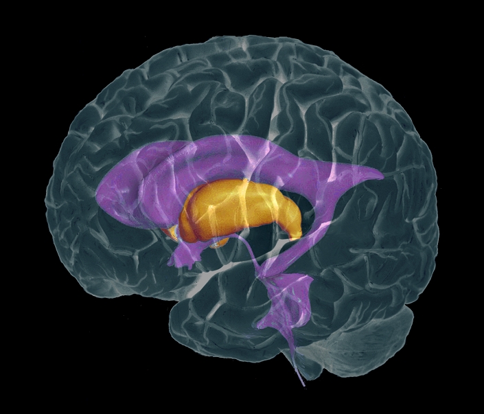 Brain ventricles. Coloured composite 3-D magnetic resonance imaging (MRI) and computed tomography (CT) scan of a brain in profile, showing the ventricles (purple). The front of the brain is at left. One of the paired thalami (orange) is seen below the ventricles. Cerebrospinal fluid (CSF) circulates in the ventricles and serves to cushion the brain and the spinal cord (not seen). The lateral ventricles connect to a small third ventricle (below front of thalami) that is between and below them. This leads down to the fourth ventricle (lower right) via the cerebral aqueduct.