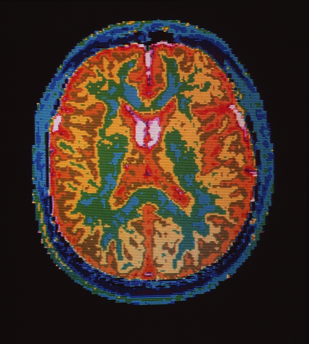 False colour nuclear magnetic resonance (NMR) image of a transverse section through a normal human brain. Fat under the skin of scalp, and bone comprising the skull appear as varying shades of blue. The image shows the clear demarcation of the outer grey and inner white matter which forms the cerebral hemispheres (the cerebrum - the bulk of brain tissue). The outer grey matter (the cerebral cortex) appears red-brown, with the underlying white matter showing up yellow varying to blue/green. The white areas represent cerebro- spinal fluid (CSF), which bathes the brain and fills the ventricles (chambers) at its centre.