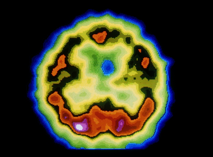 PET scan (positron emission tomography) of an axial section through a normal human brain. PET scans are obtained by injecting a tracer labelled with a short-lived radioactive isotope into the bloodstream, which concentrates in brain & emits positrons that are recorded by a circular detector when the scan is performed. Here, radioactive methionine (an amino acid) has been used to show the level of activity of protein synthesis in the brain.