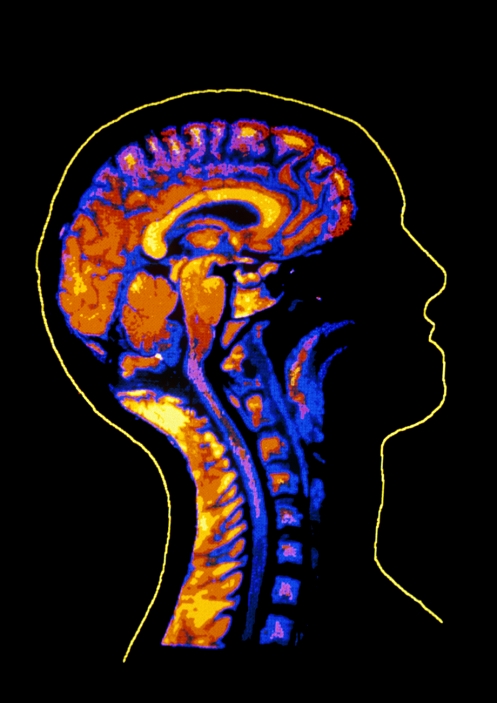 Healthy brain. Coloured Magnetic Resonance Imaging (MRI) scan of a human brain, in side view. This is a sagittal 'slice' through the brain in profile. The face is illustrated at right. The brain is yellow & orange, with cranial spaces black. At top, the cerebrum of the brain appears folded; this is the region where intelligent thought processes and memory occur. At centre is the elongated brainstem which controls involuntary reflexes; it connects with the spinal cord. An MRI scan is obtained using a powerful magnet and radio waves. It enables structures in the brain to be seen, including brain tumours.