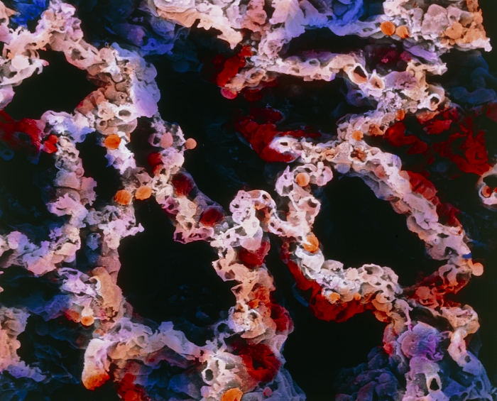 Lung tissue. False-colour scanning electron micrograph (SEM) of a section of lung tissue. The image shows several alveolar ducts and alveolar sacs (large, irregular dark areas) together with a few alveoli (smaller round dark areas). The alveoli are separated by a porous membrane known as the interalveolar septum. The tiny openings in the interalveolar septum are sectioned capillaries and it is in this intricate network of capillaries that the exchange between carbon dioxide and oxygen takes place. Many red blood cells are scattered throughout the frame. Magnification: x110 at 6x7cm size. x170 at 4x5ins