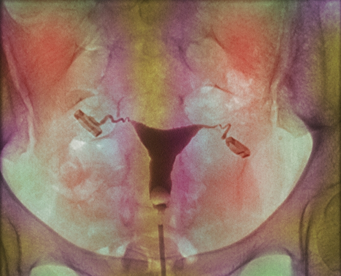 Female reproductive system. Coloured abdominal X- ray of the healthy reproductive system (brown) of a 22-year-old woman. Each month, one of her ovaries (centre left & right) releases an egg (ovum) into its fallopian tube. The fallopian tubes are attached to the uterus (lower centre). Radio-opaque dye was used to highlight the structures. It was introduced through the catheter (dark vertical line) at bottom centre.