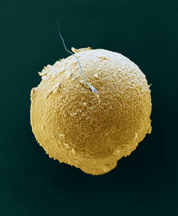 Electron micrograph of human fertilization  date unknown  Fertilisation. Coloured scanning electron micrograph  SEM  of a sperm  blue  attempting to penetrate a human egg  yellow . The sperm  spermatozoan  has a rounded head and a long tail with which it swims. Women usually release one egg  ovum  per month, whereas men release millions of sperm in each ejaculation. Only one of these sperm can penetrate the egg s thick outer layer  zona pellucida  and fertilise it. Fertilisation occurs when the sperm s genetic material  deoxyribonucleic acid, DNA  fuses with the egg s DNA. When this occurs the egg forms a barrier to other sperm. Magnification: x700 when printed 10 cm wide.