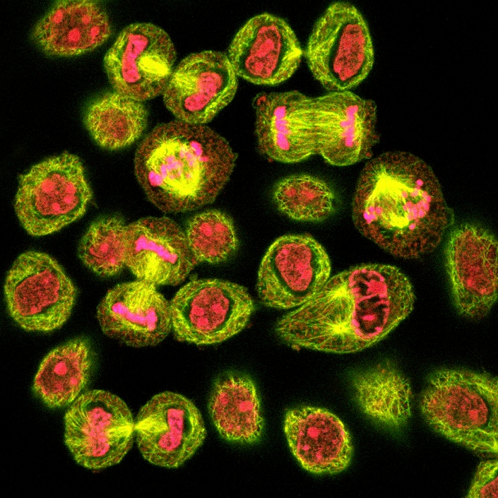 Mitosis. Confocal light micrograph of HeLa cells during mitosis (nuclear division). Mitosis is the formation of two daughter nuclei from one parent nucleus. The majority of cells are in interphase, between divisions. A cell at upper centre is in metaphase. The chromosomes (pink) are lined up along the centre of the cell. At upper right a cell is in anaphase, the two identical chromatids that make up each chromosome have been separated to opposite poles of the cell. At bottom left and top, the cells are near the end of cytokinesis (cellular division), the formation of two daughter cells. Microtubules, which are part of the cell's cytoskeleton, are yellow.