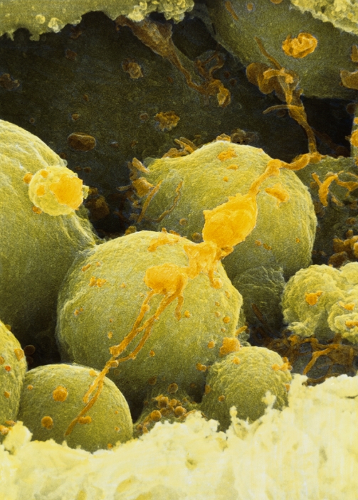 Aborting embryo cells. Coloured scanning electron micrograph (SEM) of blastomere fragments of an aborting 6-8 cell human embryo. The embryo is undergoing necrosis (tissue death). Blastomeres, the cells formed from divisions of the fertilized egg, have degenerated into fragments (green). Remains of sperm tails (orange) can also be seen. The zona pellucida (bottom, yellow), the membrane which surrounds the embryo, has been artificially fractured (opened up). It has become thick and compact and has lost its usual striated appearance. Magnification: x3,800 at 5x7cm size.