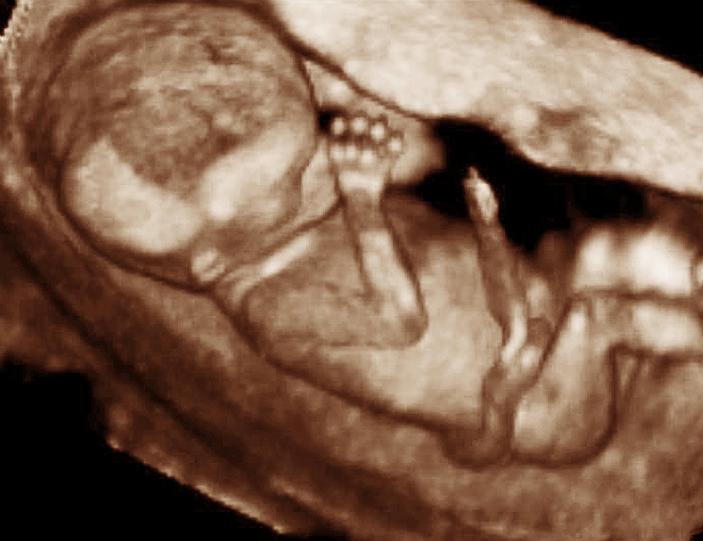 Foetal ultrasound. Three-dimensional (3-D) ultrasound scan of a human foetus. Its head is at upper left, and it appears to be sucking the thumb of its right hand. The umbilical cord is seen across its abdomen. The image was produced by a third generation 3-D ultrasound scanner called Voluson 730. 3-D scanning enables physiological disorders such as harelip and spina bifida to be diagnosed before birth. Ultrasound is a diagnostic technique which sends high-frequency sound waves into the body via a transducer. The returning echoes are recorded and used to build an image of an internal structure.