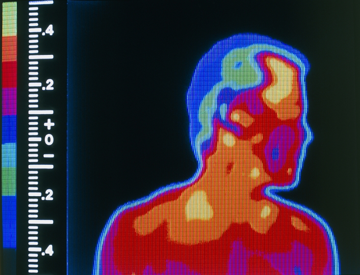 Thermogram of the head and shoulders of a naked man. Thermography is an imaging technique for mapping the heat distribution over the surface of a body. Here, the colour-coded image shows temperature variation in 0.1 degree celsius steps (see scale at left), where blue corresponds to the colder areas and yellow corresponds to the hotter areas. Thermography has proved useful in manufacturing and medicine (where it may reveal disorders such as tumours and arthritis). It was developed by the military in the 1970's and 1980's to assist night vision; the solid state sensors used in the thermograph can detect infra-red radiation even in darkness and/or smoke.