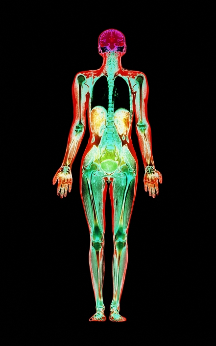Whole body MRI. Coloured magnetic resonance imaging (MRI) scan of the whole body of a woman, in coronal (frontal) section. Various parts of the anatomy of the human body are seen. The skeleton (dark green) is visible as long bones of the limbs and vertebrae of the spine. At top, the two cerebral hemispheres of the brain are seen (magenta). In the chest, the lungs are black. In the abdomen, lobes of the liver are yellow, while the bladder is rounded (green) in the pelvis. This whole body image is the product of a number of MRI scans made along the length of the body and combined. MRI scanning uses radio waves & magnetic fields to produce 'slice' images through the body.