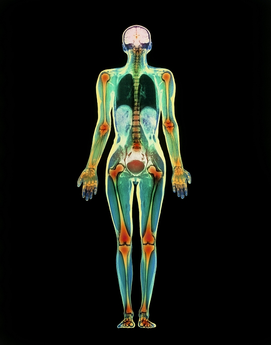 Whole body MRI. Coloured magnetic resonance imaging (MRI) scan of the whole body of a woman, in coronal (frontal) section. Various parts of the anatomy of the human body are seen. The skeleton (orange) is visible as long bones of the limbs and vertebrae of the spine. At top, the two cerebral hemispheres of the brain are seen (white). In the chest, the lungs are dark green. In the abdomen, lobes of the liver are light blue, while the bladder is rounded (red) in the pelvis. This whole body image is the product of a number of MRI scans made along the length of the body and combined. MRI scanning uses radio waves & magnetic fields to produce 'slice' images through the body.
