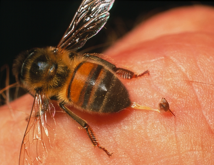 Bee sting. View of a honeybee Apis mellifera in the process of stinging a human finger. At centre right, the sting has embedded in skin, while the bee pulls away rupturing its seventh abdominal segment and mortally injuring itself. The sting carries with it nerve and muscle tissue that work to pump poison (peptides) into the finger. The tip of the sting is armed with backward sloping barbs which make it difficult to remove once embedded. Cells around the sting also exude a pheromone odour that attracts other bees to attack the same site. Only female worker bees are able to sting. This barbed device was originally an egg-laying organ that evolved into a weapon of defence.