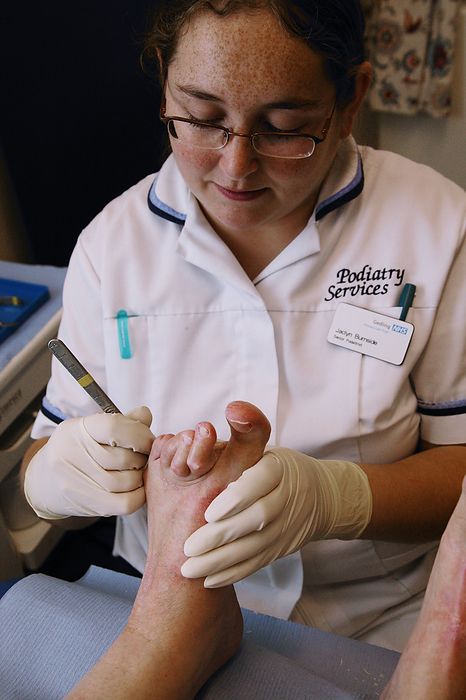 Senior podiatrist debriding callus Senior Podiatrist debriding callus on Podiatry outpatients feet.