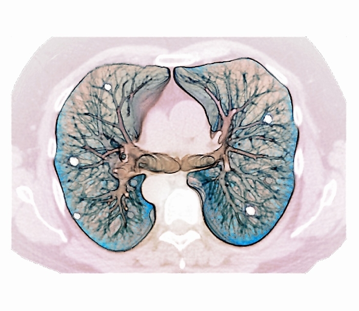 Secondary lung cancer, 3D CT scan Secondary lung cancer. Coloured 3D computed tomography  CT  scan of a section through the lungs of a 64 year old male patient, showing diffuse cancerous lesions that have metastasised  spread  from prostate cancer.
