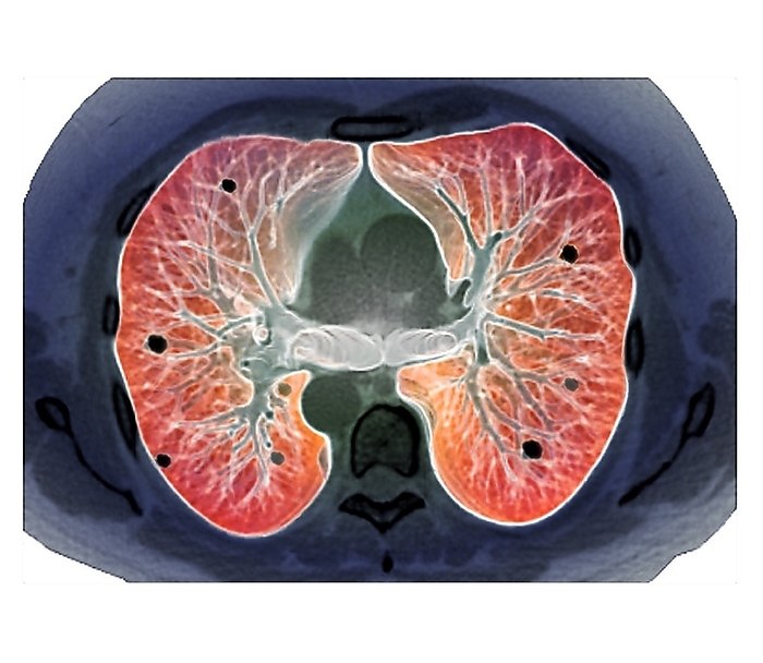 Secondary lung cancer, 3D CT scan Secondary lung cancer. Coloured 3D computed tomography  CT  scan of a section through the lungs of a 64 year old male patient, showing diffuse cancerous lesions that have metastasised  spread  from prostate cancer.