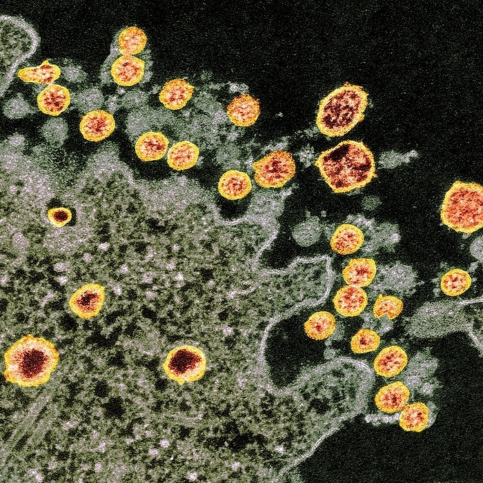 Covid 19 coronavirus, TEM Coloured transmission electron micrograph  TEM  of Covid 19 coronavirus particles  orange  isolated from the first US case of the virus. Covid 19  previoulsy 2019 nCoV  was first identified in Wuhan, China, in December 2019. It is an enveloped RNA  ribonucleic acid, dark red  virus. The coronaviruses take their name from their crown  corona  of surface proteins, which are used to attach and penetrate their host cells. Covid 19 causes a respiratory infection that can lead to fatal pneumonia. As of the 10th February 2020, over 40,000 have been infected in China with over 900 deaths. There have been over 300 confirmed cases outside of China, with one death. In China travel restrictions and infection control measures have been put in place to slow the spread of the virus.