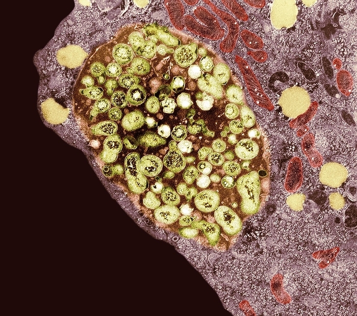 Chlamydia bacteria in a lung cell, TEM Coloured transmission electron micrograph  TEM  of Chlamydia pneumoniae bacteria inside a lung cell. The brown area at centre is an inclusion body containing bacteria  yellow  at different stages in their life cycle. Chlamydia species bacteria are unusual in that they are obligate intracellular parasites, living and reproducing only inside cells. Human infection with C. pneumoniae is common and most often asymptomatic. However, it can cause community acquired pneumonia and laryngitis. Infection with C. pneumoniae has been shown to be a risk factor for developing atherosclerosis  fatty plaques  in blood vessels. Magnification: x13,000 when printed at 10 centimetres across.