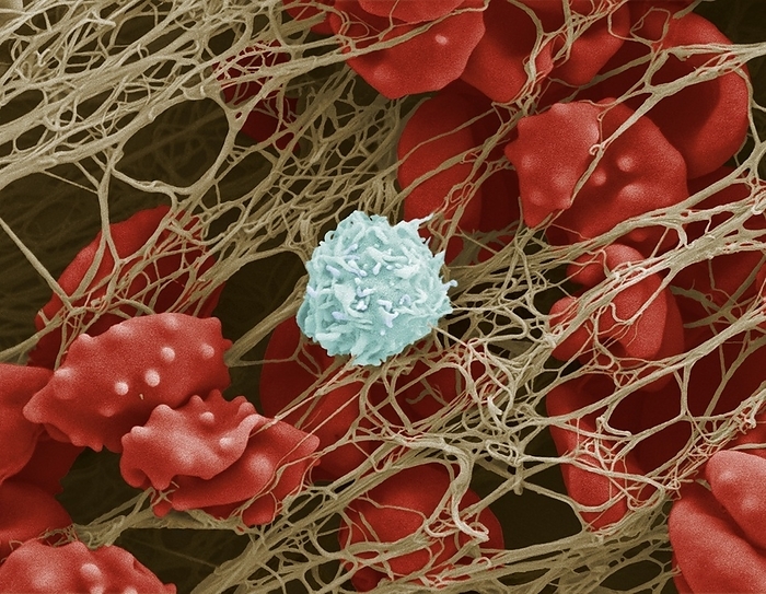 Crenated red blood cells in blood clot, SEM Crenated red blood cells  erythrocytes  and a single white blood cell  leucocyte  in a fibrin mesh, coloured scanning electron micrograph  SEM . A blood clot is forming with many erythrocytes  red  and a single leucocyte  white blue  becoming entangled in a fibrin net  light brown . Erythrocytes contain the iron rich protein haemoglobin which binds oxygen. Erythrocytes transport oxygen from the lungs to the rest of the body and also remove carbon dioxide from the body by transporting it to the lungs where it is exhaled. However, these erythrocytes are crenated as depicted by the spiny knobs dispersed over the cell surface. This may be caused by hyperosmotic conditions or can be associated with the pathological condition uraemia. Leucocytes only account for about 1 per cent of blood but they are essential in protecting against illness and disease. Leucocytes will travel to areas infected by a virus or bacteria to destroy any potential threat and prevent illness. The blood cells here