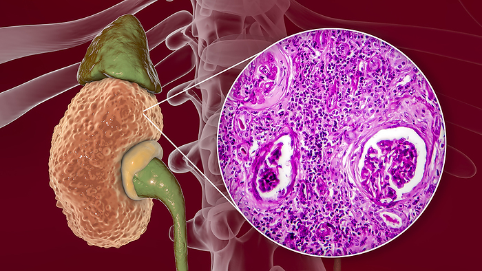 Chronic kidney disease, illustration and light micrograph Chronic kidney disease, computer illustration and light micrograph. The illustration shows the gross anatomy of kidneys with chronic glomerulonephritis. The kidneys are atrophied with a thin cortex and cysts that create a bumpy appearance. The light micrograph shows histopathology of the diseased kidney with atrophied glomeruli. The chronic form of glomerulonephritis may develop in adults following a streptococcal throat infection. It is seen clinically as low urine production  oliguria , high blood pressure and urea retention.