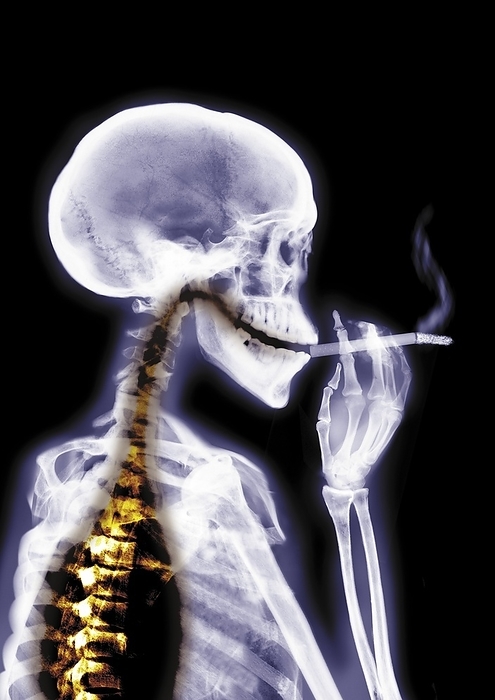Person smoking, X ray Person smoking, coloured X ray.