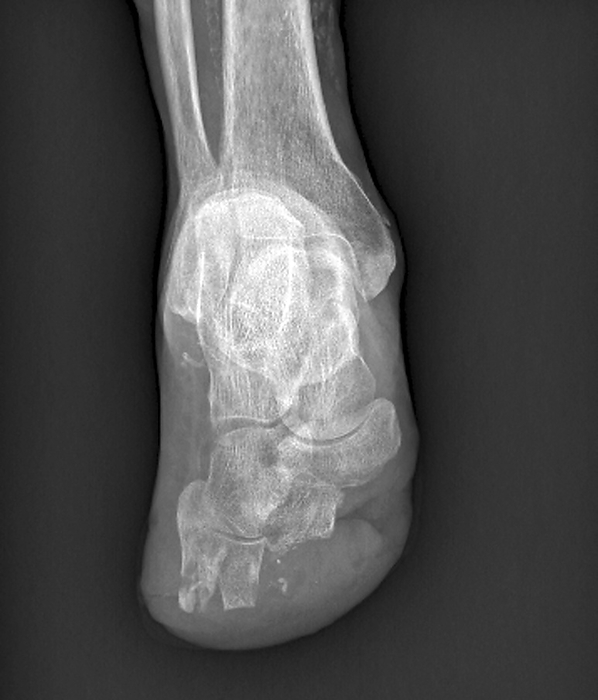 Diabetic amputeee, X ray X ray of the left foot of a 67 year old male patient with diabetes who has had part of his forefoot amputated due to circulatory problems. Diabetics often develop ulcers on the feet due to inadequate blood supply or neuropathy  nerve damage  caused by the disease. In severe cases, the ulcers can become gangrenous necessitating removal of the affected region.