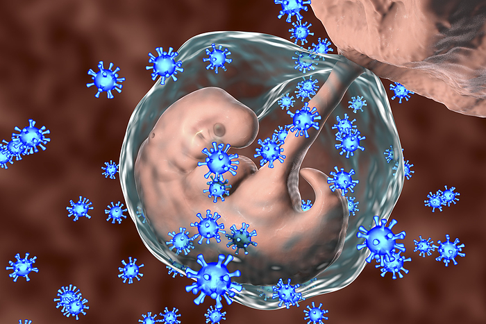 Viruses infecting human embryo, conceptual illustration Viruses infecting human embryo, conceptual illustration. The embryo is 4 weeks old. Many viruses cause foetal abnormalities or stillbirth. For example, rubella, herpes and cytomegalovirus cause different foetal pathology, whilst foetal measles infection usually leads to stillbirth.