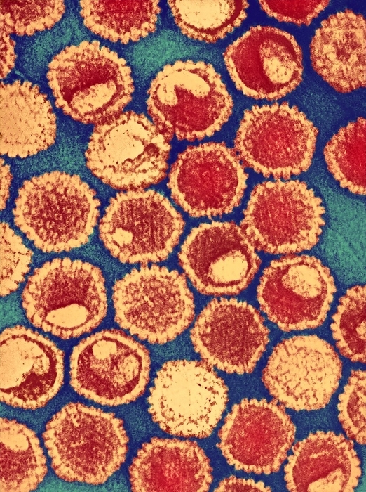Herpes virus particles, TEM Herpes virus particles, coloured transmission electron micrograph  TEM . Each particle  virion  consists of a deoxyribonucleic acid  DNA  core  red  surrounded by an icosahedral capsid  orange , which is itself surrounded by an envelope covered in glycoprotein spikes  red outline . Members of the herpes virus family include several that infect humans: herpes simplex viruses type 1 and type 2  oral and genital herpes , varicella zoster virus  chicken pox and shingles , Epstein Barr virus  glandular fever  and cytomegalovirus  various infections .