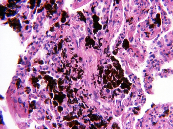Pneumoconiosis, light micrograph Pneumoconiosis. Light micrograph of a section through lung tissue affected by pneumoconiosis, a disease caused by the inhalation of pollutants such as coal and silica dust. Deposits of dust particles  black  can be seen in the tissue. The accumulation of these deposits leads to inflammation, fibrosis  scarring  and ultimately necrosis  death  of the lung tissue. Symptoms include breathlessness, a chronic cough and increased susceptibility to lung infections. There is no cure.