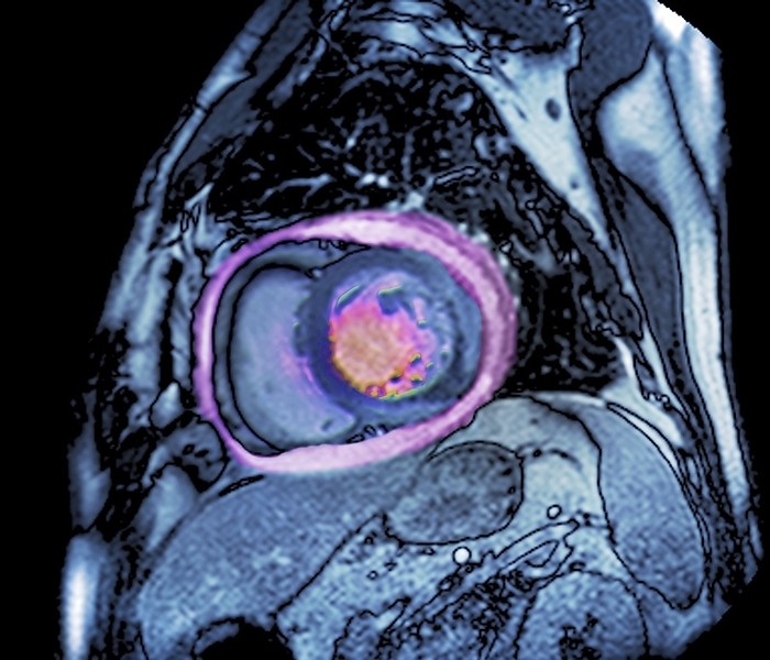Fluid around heart in heart failure Coloured MRI scan of a sagittal  longitudinal  section through the chest of a patient aged 60 some time after a heart attack  myocardial infarction  showing build up of fluid in the pericardial space  pink  around the heart  centre left . This fluid build up is due to heart failure.