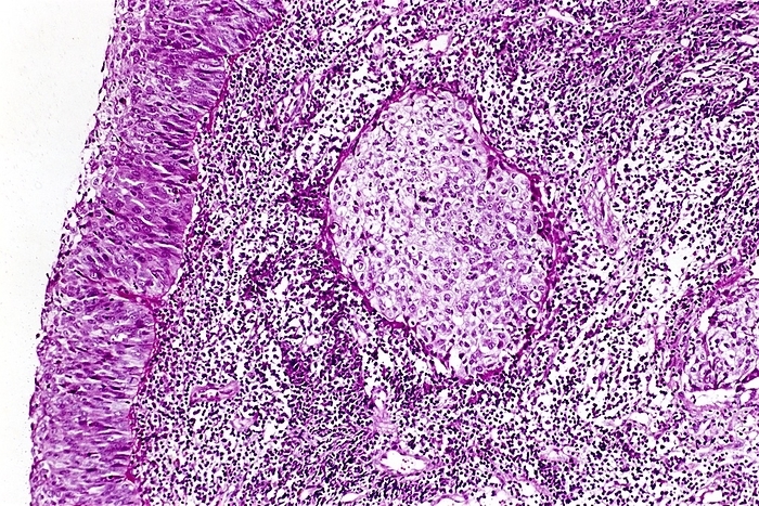 Nose and throat cancer, light micrograph Nose and throat cancer. Light micrograph of a section through throat tissue showing a nasopharyngeal carcinoma  NPC, centre . NPC is a malignant  cancerous  tumour arising from the mucus lining  mucosal epithelium  of the nasopharynx. The nasopharynx is the uppermost part of the throat, where it meets the nasal cavity. This tumour may have arisen due to smoking tobacco or eating nitrosamine rich foods  such as salt cured fish , or possibly as a result of being infected with Epstein Barr Virus  EBV . The most effective treatment is a combination of radiation therapy and chemotherapy.