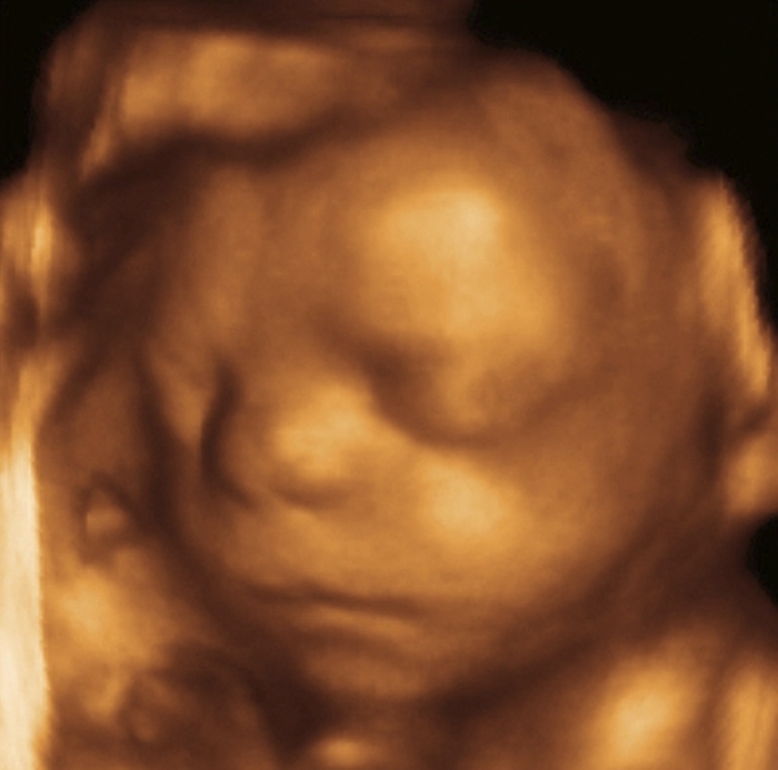 Foetus at 26 weeks, 3 D ultrasound scan Foetus  face. Coloured 3 D ultrasound scan of the face of a foetus at 26 weeks  end of the second trimester . The foetus  left eye is at centre, with the nose and mouth slightly to the left and below it. The right side of its face is resting against the placenta  left . Ultrasound scanning uses high frequency sound waves to create an image of an internal structure. Foetal ultrasound scanning is routine during pregnancy. 3 D scanning uses computer technology to return more detailed images than conventional 2 D scans.