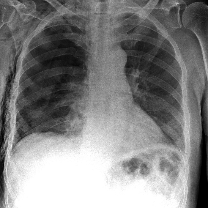 Tension pneumothorax, X ray Tension pneumothorax. X ray of the chest of a patient with tension pneumothorax that has lead to soft tissue emphysema. Tension pneumothorax is a progressive deterioration and worsening of a simple pneumothorax  collapsed lung . The right lung  dark area, right  has collapsed due to a build up of air  solid grey  between the lung and chest wall. In emphysema, the lung tissues necessary to support the physical shape and function of the lung are destroyed. It is a progressive disease that primarily causes shortness of breath.