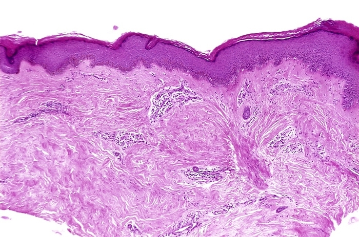 Keratoacanthoma, light micrograph Keratoacanthoma. Light micrograph of a section through a keratoacanthoma nodule. The surface layers are across top, including the hard keratin layer. Below this there are patches of inflammation and white blood cells with stained nuclei  dark spots . The cause of a keratoacanthoma lesion is unknown but it has many features of a viral condition, and consists of a localised proliferation of squamous cells that forms a cratered nodule. The nodule grows over several weeks before gradually disappearing. However, the unsightly nodule is often surgically removed. The cause of keratoacanthoma is unknown, although exposure to sunlight appears to be a factor.