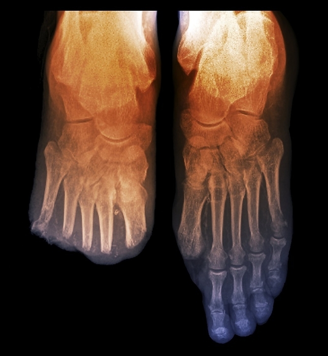 Toe amputations in diabetes, X ray Toe amputations in diabetes. Coloured frontal X ray of the feet of a 69 year old patient with diabetes whose has had toes amputated due to circulatory problems. All the toes of the right foot  left  were amputated, as well as the big toe of the left foot  right . Diabetics often develop ulcers on the feet due to inadequate blood supply or neuropathy  nerve damage  caused by the disease. In severe cases, the ulcers can become gangrenous necessitating removal of the affected region.