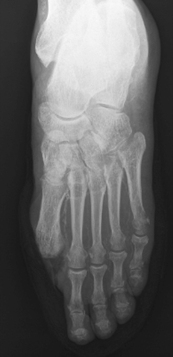 Toe amputation in diabetes, X ray Toe amputation in diabetes. Frontal X ray of the left foot of a 69 year old patient with diabetes who has had the big toe  lower left  amputated due to circulatory problems. Diabetics often develop ulcers on the feet due to inadequate blood supply or neuropathy  nerve damage  caused by the disease. In severe cases, the ulcers can become gangrenous necessitating removal of the affected region.