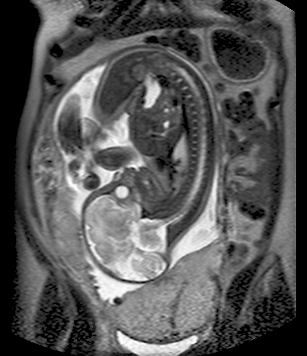 Placenta previa, MRI scan Placenta previa. Pelvic magnetic resonance imaging  MRI  scan of a 36 year old pregnant woman with placenta previa. This disorder involves the placenta  lower centre  covering the cervix, the exit to the uterus. The patient, who was unaware of the pregnancy, had failed to have a period for 33 weeks, and had instead been suffering irregular uterine bleeding due to this condition. The foetus  head down  is seen in sagittal view, revealing its brain  lower left .