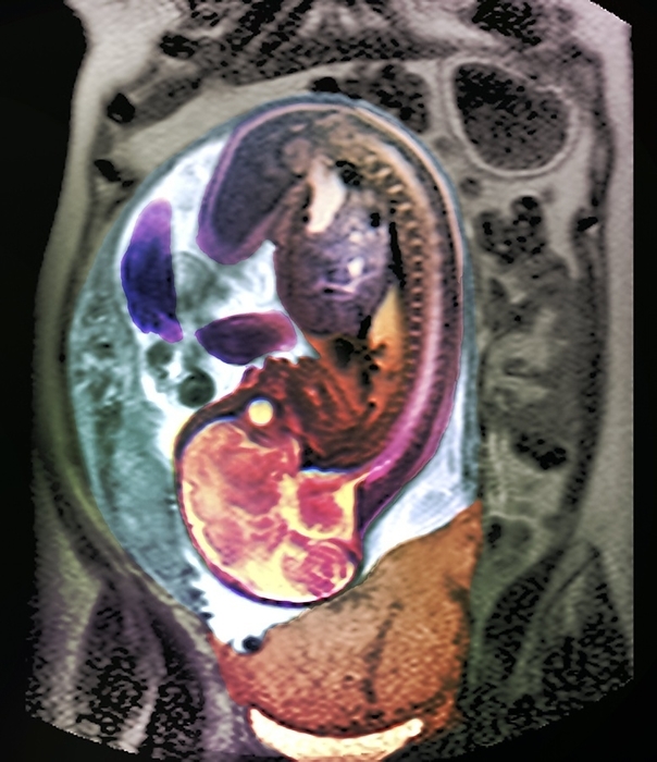 Placenta previa, MRI scan Placenta previa. Coloured pelvic magnetic resonance imaging  MRI  scan of a 36 year old pregnant woman with placenta previa. This disorder involves the placenta  lower centre  covering the cervix, the exit to the uterus. The patient, who was unaware of the pregnancy, had failed to have a period for 33 weeks, and had instead been suffering irregular uterine bleeding due to this condition. The foetus  head down  is seen in sagittal view, revealing its brain  lower left .