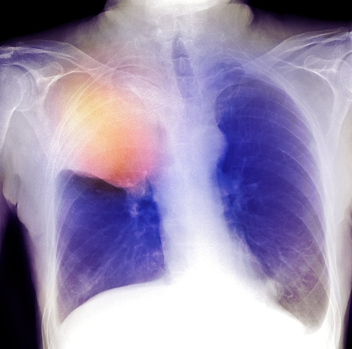 Lung cancer, X ray Lung cancer. Coloured frontal X ray showing a bronchial carcinoma  orange  in the upper lobe of a patient s right lung  blue, left . The cancer has lead to a lack of gas exchange within the lung s alveoli  atelectasis . The diaphragm  white, bottom  can also be seen to be elevated on the right hand side.