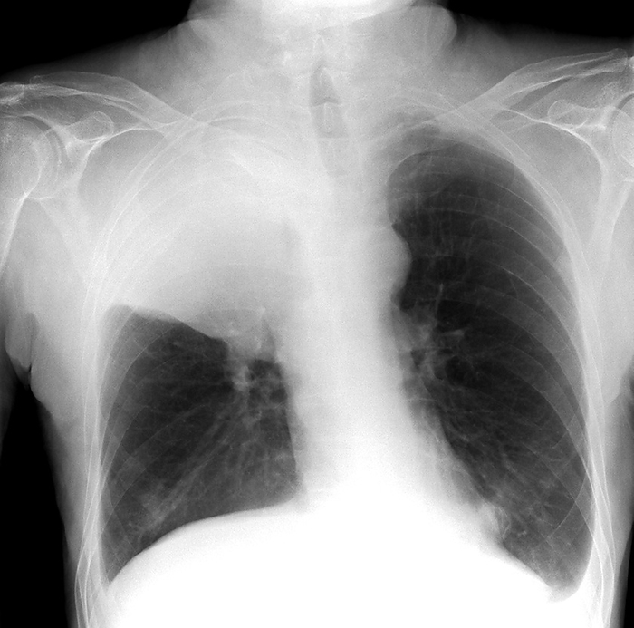 Lung cancer, X ray Lung cancer. Frontal X ray showing a bronchial carcinoma  white, upper left  in the upper lobe of a patient s right lung  dark, left . The cancer has lead to a lack of gas exchange within the lung s alveoli  atelectasis . The diaphragm  white, bottom  can also be seen to be elevated on the right hand side.