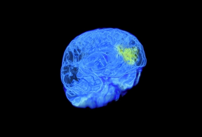 Child s brain activity, MRI scan Child s brain activity. Coloured MRI  magnetic resonance imaging  scan of a child who is looking at themselves in a mirror. This shows the area  yellow  of the frontal cortex in the brain that is associated with the sense of self.