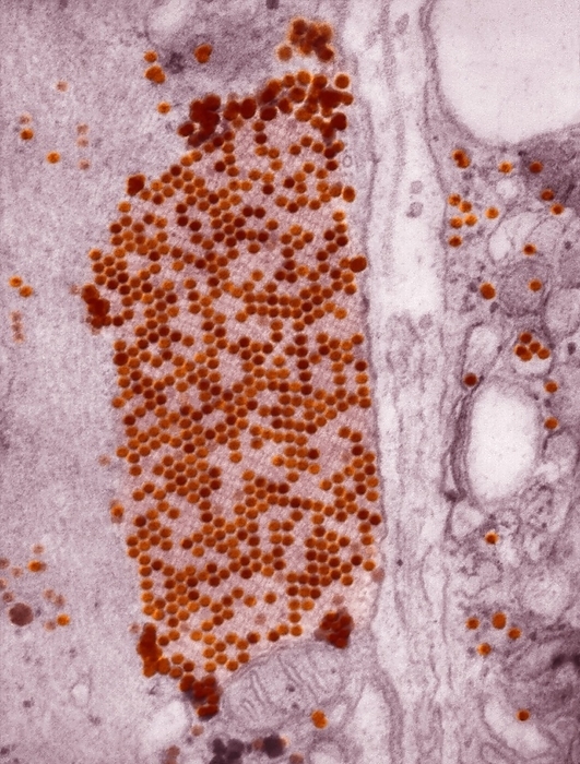 Coxsackie B3 virus particles, TEM Coxsackie B3 virus particles. Transmission electron micrograph  TEM  of Coxsackie B3 virions  particles, orange  in muscle tissue. Coxsackie viruses, of which there are many types, are enteroviruses and are part of the Picornaviridae group. Symptoms of infection with viruses in the Coxsackie B subgroup include fever, headache, sore throat, gastrointestinal distress, as well as chest and muscle pain.