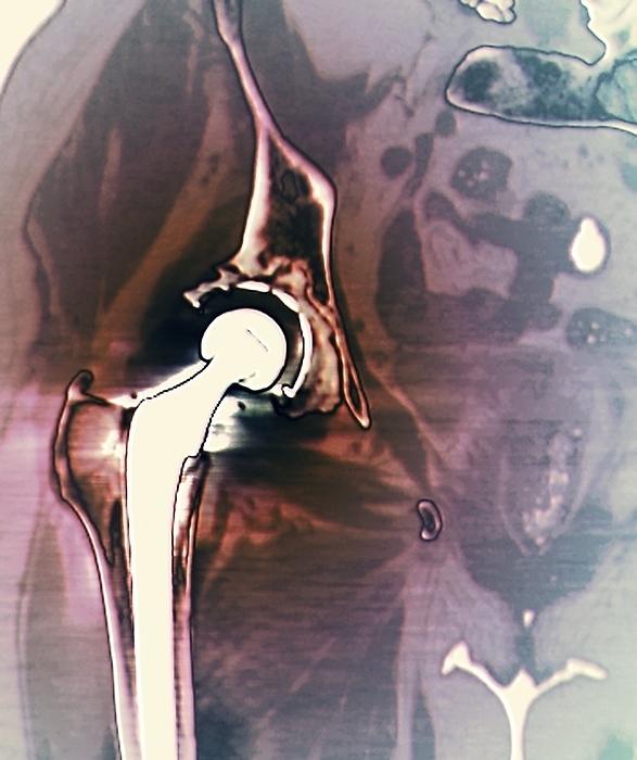 Failed hip replacement, CT scan Failed hip replacement. Coloured computed tomography  CT  scan of a total hip replacement  solid white  in a 70 year old patient. This scan shows that the orthopaedic cement, which holds the implanted socket  white crescent  into the acetabular cup  centre left  of the pelvic bone, has degraded leading to the loosening of the implant.