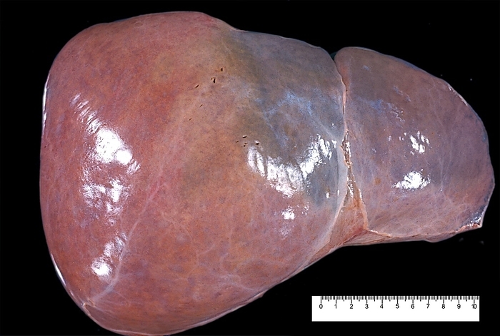 Unhealthy human liver Human liver with a bluish surface on the lateral and medial segments  segments II to IV . This colouring can be seen in several pathologies, such as suprahepatic vein thrombosis or portal hypertension causing a sinusoidal congestion. The actual size can be determined with the rule below.