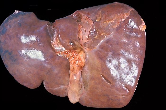 Unhealthy human liver Human liver. The surface of the entire base of the liver shows bluish areas, more concentrated in the left lobe. This colouring can be seen in several pathologies such as suprahepatic vein thrombosis or portal hypertension causing a sinusoidal congestion.
