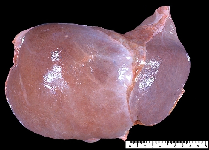 Congestive hepatopathy Human liver in a case of chronic passive hepatic congestion, a common complication of congestive heart failure, wherein elevated central venous pressure is directly transmitted from the right atrium to the hepatic veins. The liver is enlarged and shows a nutmeg pattern on its surface. The actual size can be determined with the rule below.