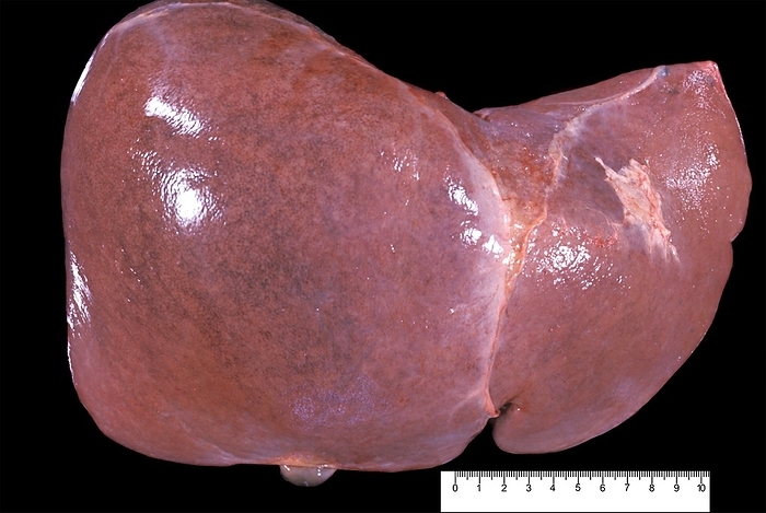 Congestive hepatopathy Human liver in a case of chronic passive hepatic congestion, a common complication of congestive heart failure, wherein elevated central venous pressure is directly transmitted from the right atrium to the hepatic veins. The liver is enlarged and shows a nutmeg pattern on its surface. The actual size can be determined with the rule below .